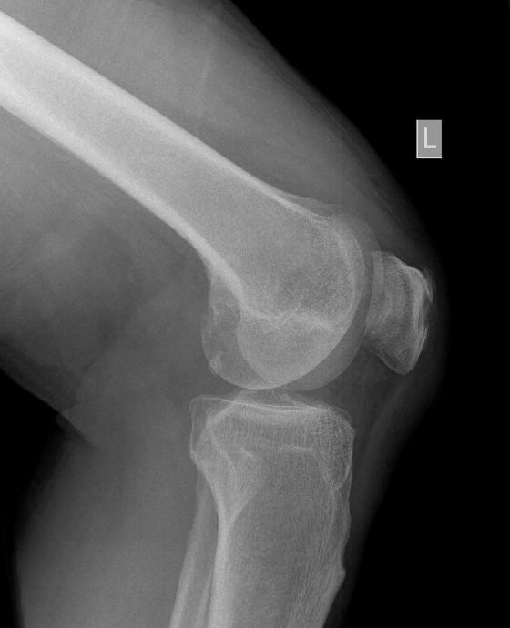 Figure 2 for case gout arthritis ( RID3567 )